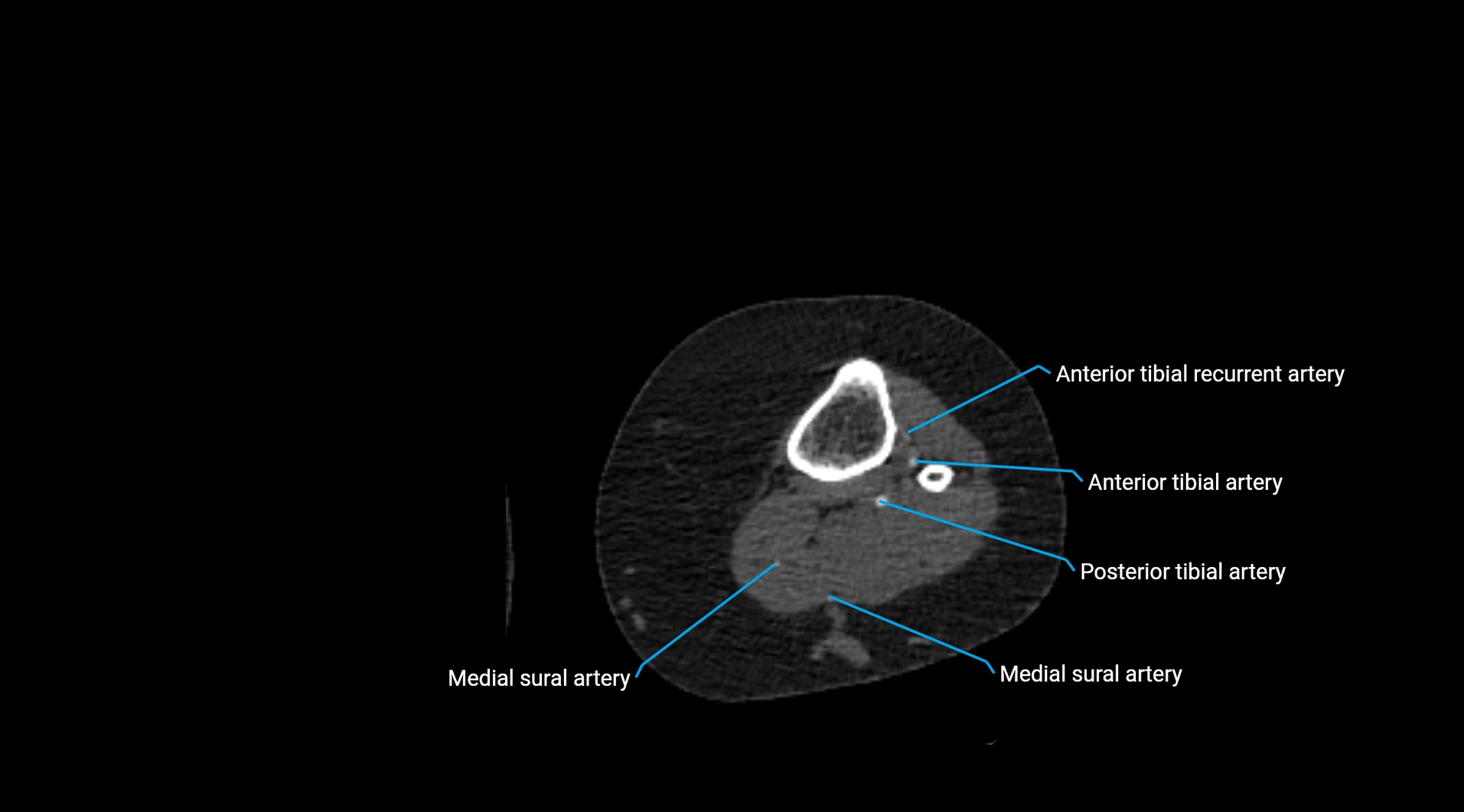 CTA lower limb cross sectional anatomy labelled image _188.webp